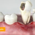 Photo of the tooth extraction process