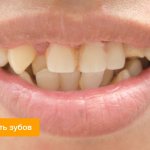 Photo of crowded teeth