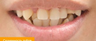 Photo of crowded teeth