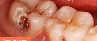 Photo of average caries of the seventh and sixth teeth