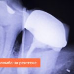 Фото световой пломбы на рентгене