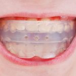 Photos of teeth trainers