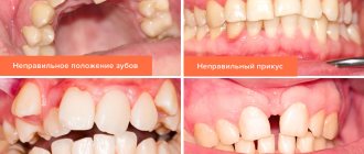 Photos of types of malocclusion