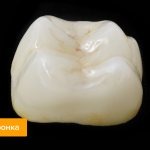 Photo of a dental crown
