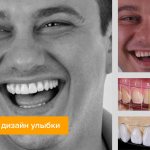 Фото зубов пациента до и после цифрового дизайна улыбки