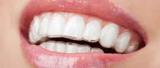 Photo of teeth with aligners on.