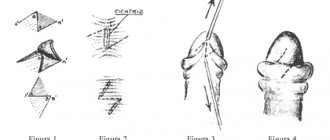 Frenulotomy of the frenulum