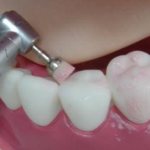 Фторирование зуба