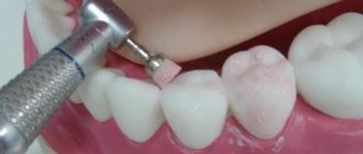 Фторирование зуба