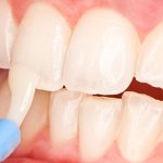 Fluoridation of teeth