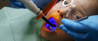 Sealing teeth in children