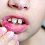 Herpetic stomatitis in a child