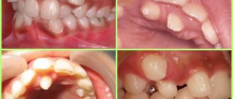 Гипердентия - аномалия числа зубов