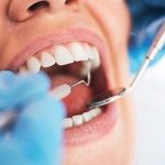 Granulating periodontitis