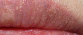 Fordyce granules on the lips. Photos, causes, symptoms, treatment, how to get rid of 