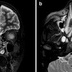Fungal sinusitis on an MRI image