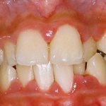 Chronic periodontitis