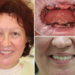 имплантация челюсти при полном отсутствии зубов