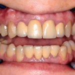 Имплантация двух зубов — особенности и варианты - фото до лечения