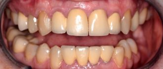 Implantation of two teeth - features and options - photos before treatment