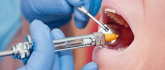 infiltration anesthesia in dentistry