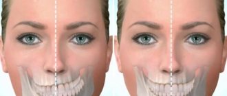 Исправление асимметрии челюсти у взрослых
