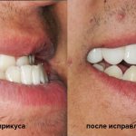 correction of malocclusion