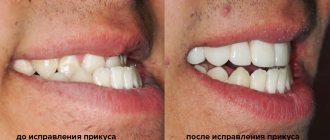 correction of malocclusion