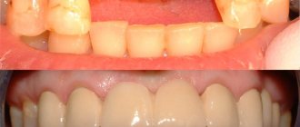 Изготовление коронки на зуб из металлокерамики, плюсы и минусы, фото до и после