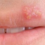 How to quickly cure herpes on the lip using folk remedies?
