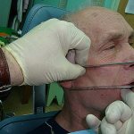 Как определяется центральная окклюзия при частичном отсутствии зубов