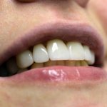 How to restore a front tooth in one visit to the dentist? Direct veneers will help 