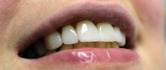 How to restore a front tooth in one visit to the dentist? Direct veneers will help 