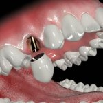 How to place a crown on an implant