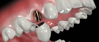 How to place a crown on an implant