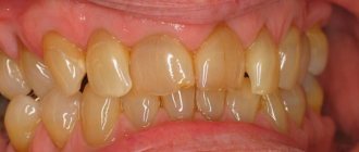 how to remove yellow plaque from cigarettes on teeth