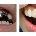 Как ухаживать за зубами из металлокерамики чем чистить
