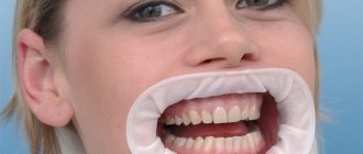 Как устанавливается ретрактор Оптрагейт в стоматологии