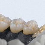 как восстанавливают зубы протезированием
