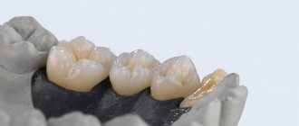 как восстанавливают зубы протезированием