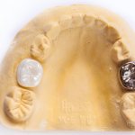 what does a crown look like on baby teeth?