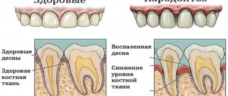 What does periodontal disease look like?