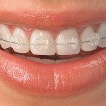Which braces are better to install?