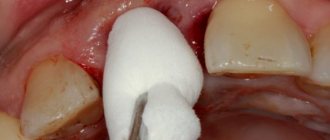 What medicine is put into the hole after tooth extraction?