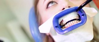 What is real whitening like - Smile Line
