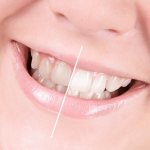 What is the safest and most effective teeth whitening?