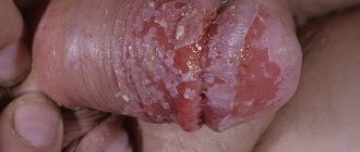 candidiasis of the head and foreskin