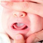oral candidiasis in infants