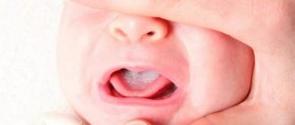 oral candidiasis in infants