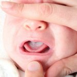 oral candidiasis in a child